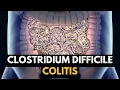 Lagu CLOSTRIDIUM DIFFICILE COLITIS, Causes, Signs and Symptoms, Diagnosis and Treatment.