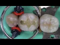 Class II composite restoration