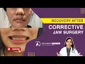 How Long Does it Take to Recover From a Corrective Jaw Surgery