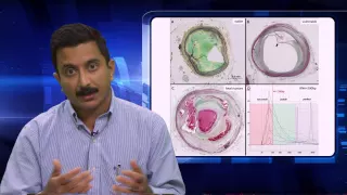 Genomics of Sudden Coronary Death: What Causes Atherosclerotic Plaques to Rupture - Shurjo Sen