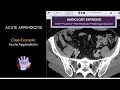 ACUTE APPENDICITIS Case Example - Acute Appendicitis on CT 4410