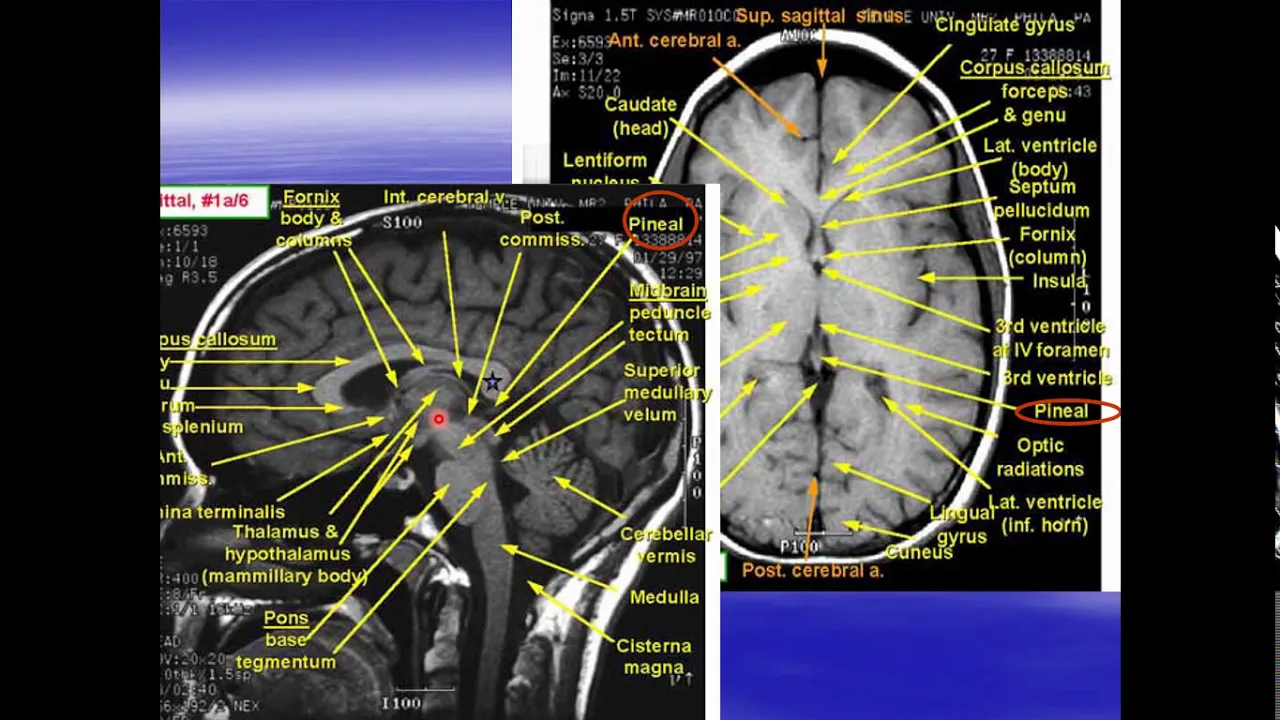 radiological anatomy of the brain part II