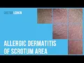 Allergic dermatitis of scrotum area