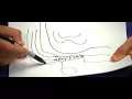 What are the different techniques of Inguinal hernia surgery