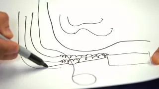 What are the different techniques of Inguinal hernia surgery