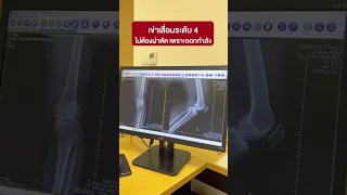 ใช้เวลานานแค่ไหนถึงเห็นผลจากการออกกำลังกายสำหรับข้อเข่าเสื่อม