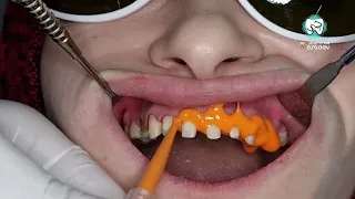 أخذ طبعة سيلكون مع تعويض مؤقت دندنها