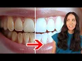 If You Have Stained Teeth DO THIS