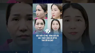Căng da chỉ APTOS – Nâng đỡ đường nét, trẻ hóa gương mặt
