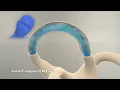 Half Somersault Maneuver to Treat BPPV Vertigo