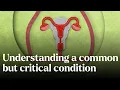 Download Lagu Understanding a common but critical condition - Nature's Building Blocks | BBC StoryWorks