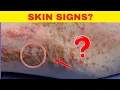 Diabetische huidsymptomen die u NOOIT mag negeren!