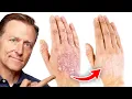 The Best Remedy for Eczema