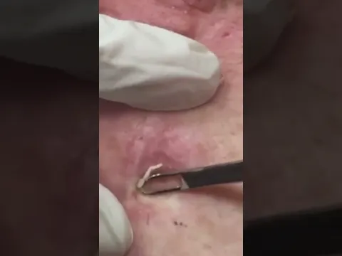 Deep Blackhead Extraction: Soft Pop