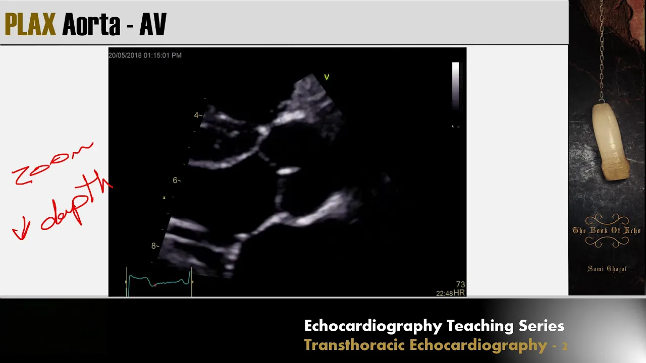 Lecture 3 - Transthoracic Echocardiography Part 2