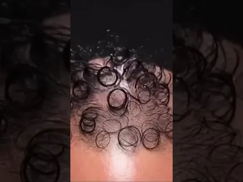 Hair Transplant Technology 2025 | #shorts #shortsfeed #ytshorts #youtubeshorts #hairtransformation
