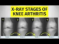 Knee Arthritis X-ray Stages What You Need To Know