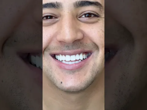 إحصل على أسنان أكثر بياضا و إشراقاً في جلسة واحدة ✨ #dentist #whitening #dentalclinic