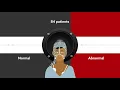 Download Lagu Detecting Silent Seizures By Their Sound Video Abstract