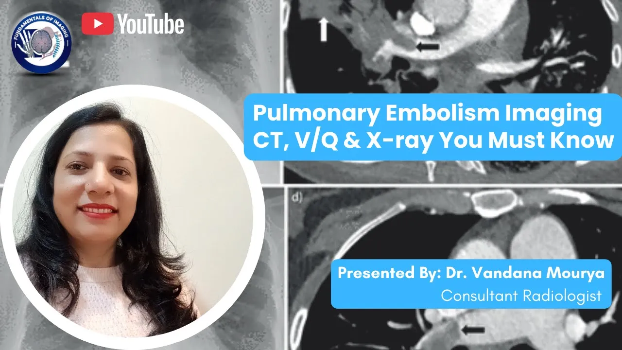 Pulmonary Embolism Imaging Algorithm: CTPA, VQ & X ray You Must Know