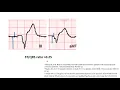 New LBBB is it STEMI Updated STEMI ECG criteria in LBBB beyond Sgarbossa Elias Hanna
