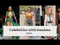 Celebrity feet Celebrities with bunions Calla Shoes