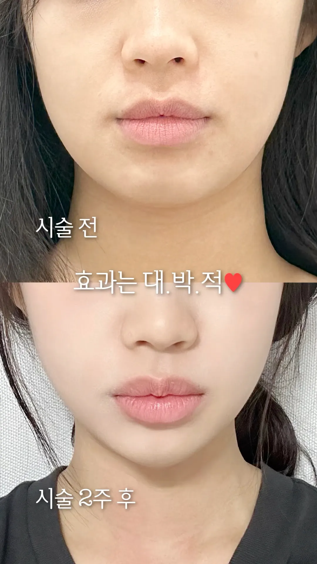 다이어트를 해도 이중턱은 그대로라면?