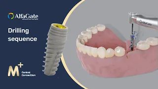How to place M dental implant drilling sequence Alfa Gate