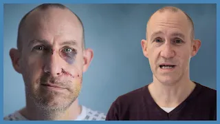 Doctors Rebuild His Face After A Brutal Cycling Crash | The Face Doctors