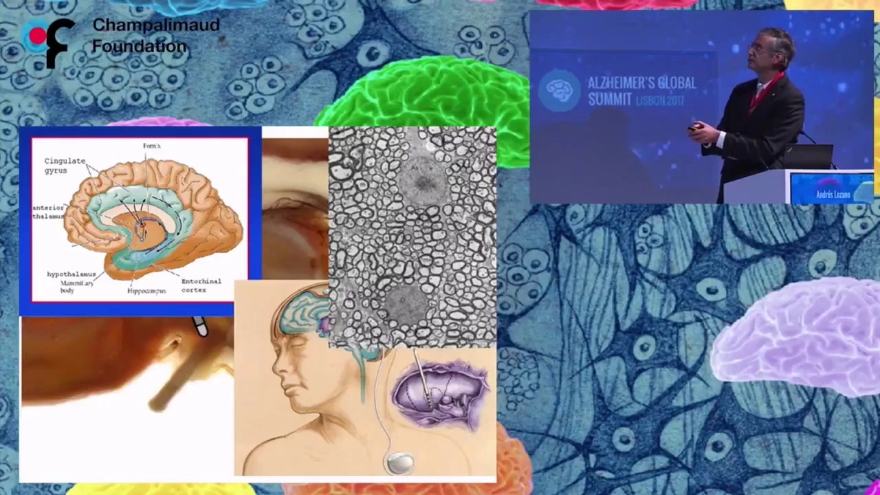 Andrés Lozano - Alzheimer's Global Summit - XI CIBERNED SCIENTIFIC FORUM 22/09/2017