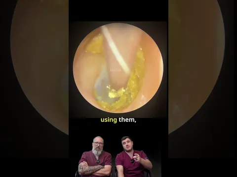 Why You Shouldn't Use Cotton Buds: Wax Hooked Against the Eardrum #Shorts