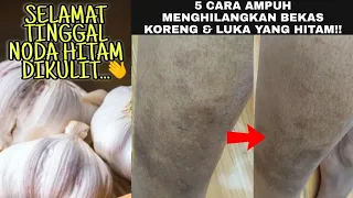 Download 5 CARA AMPUH MENGHILANGKAN BEKAS KORENG/LUKA YANG HITAM \u0026 BANDEL! MP3