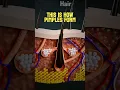 Download Lagu “How Pimples Form”? video credit: @ProfessorOfHow (Youtube.com)