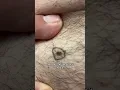 Dermatologist with 50 years experience shows mole to remove and check for cancer