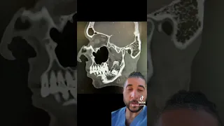 Case Study CT of Dentigerous Cyst