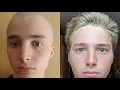 Download Lagu Hair Growth Time Lapse - 4 Months