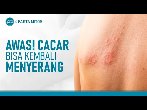 Waspada! 3 Jenis Cacar Ini Bisa Kambuh Lagi