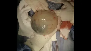 ولادة قيصرية خروج للبيبي في كيس الحمل 