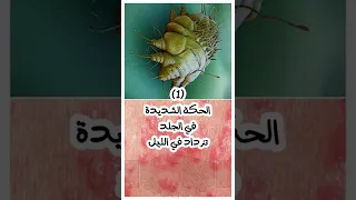 اعراض مرض الجرب عند الانسان   احذر من الجرب فى الشتاء    اعرف علاماته وسارع بالكشف دندنها