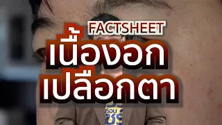 การรักษาเนื้องอกที่เปลือกตาทำอย่างไรบ้าง