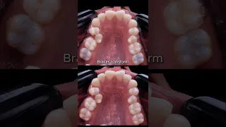 Braces transformation - crooked teeth not extraction