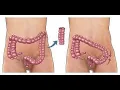 Colectomy CPT code - simplify medical coding