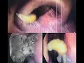 Download Lagu Maggots in Nose/ Nasal Myiasis- Dr. V. Narendrakumar