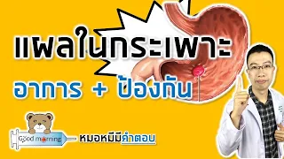 จะป้องกันการเกิดแผลในกระเพาะอาหารได้อย่างไรบ้าง