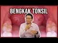 Download Lagu Bengkak Tonsil : Apa dan Punca? Tahap Bengkak dan Rawatan Acute Tonsillitis.