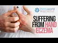 Suffering from hand eczema