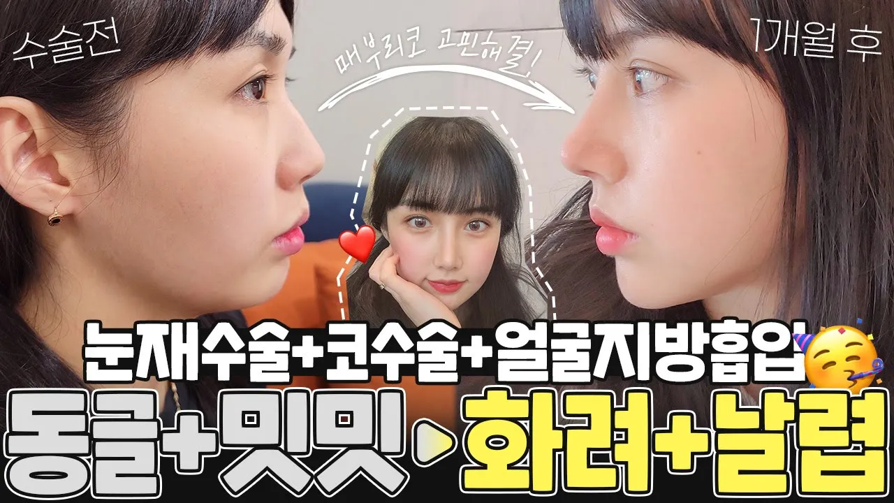 과하지 않은 성형이이란 이런 것? #메부리코 #눈재수술 #얼굴지방흡입