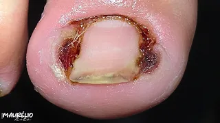 2 ANOS DE UNHA ENCRAVADA ACABARAM EM 37 MINUTOS — VEJA O RESULTADO #podologomaurelio #satisfying