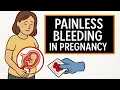 What is Placenta Previa Causes Signs and Emergency Management