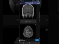 Download Lagu Neuroradiology - Acute Disseminated EncephaloMyelitis - ADEM